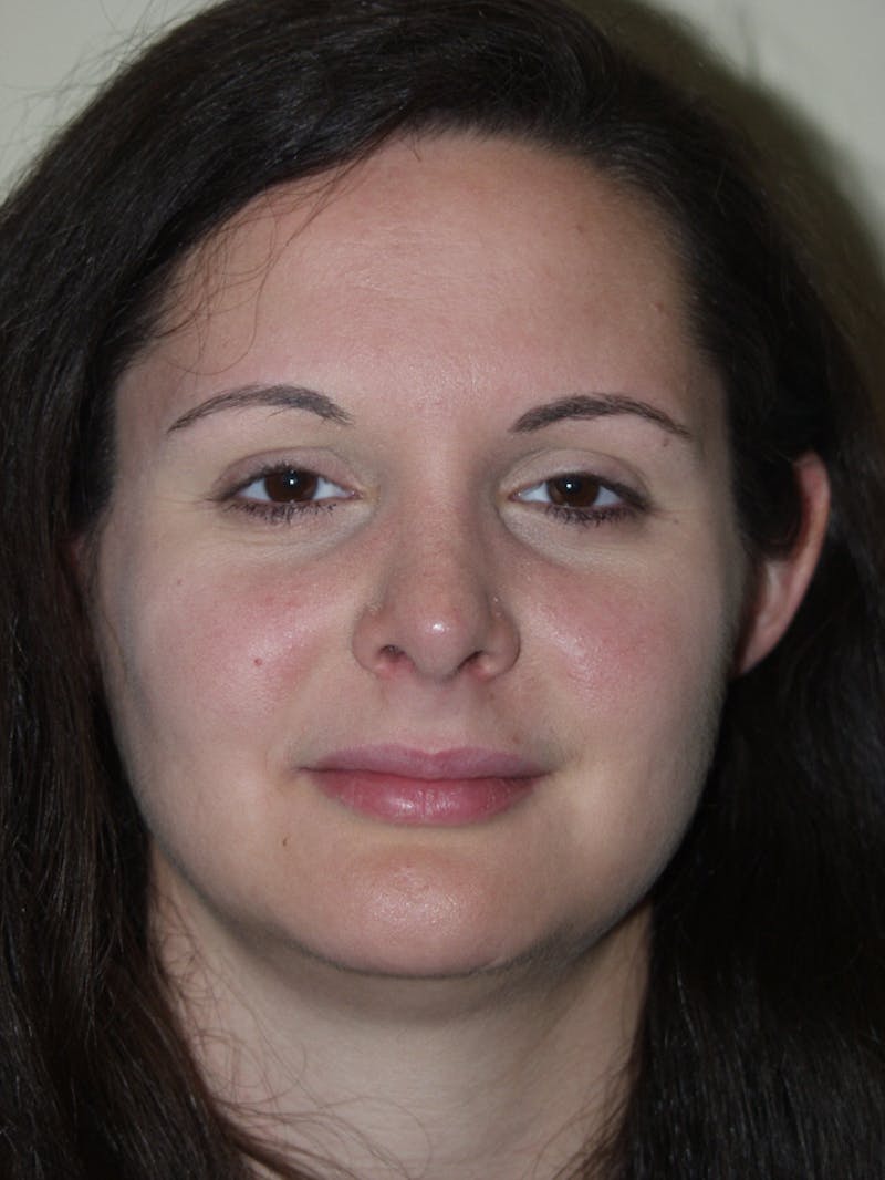 Rhinoplasty Before & After Gallery - Patient 53825281 - Image 4
