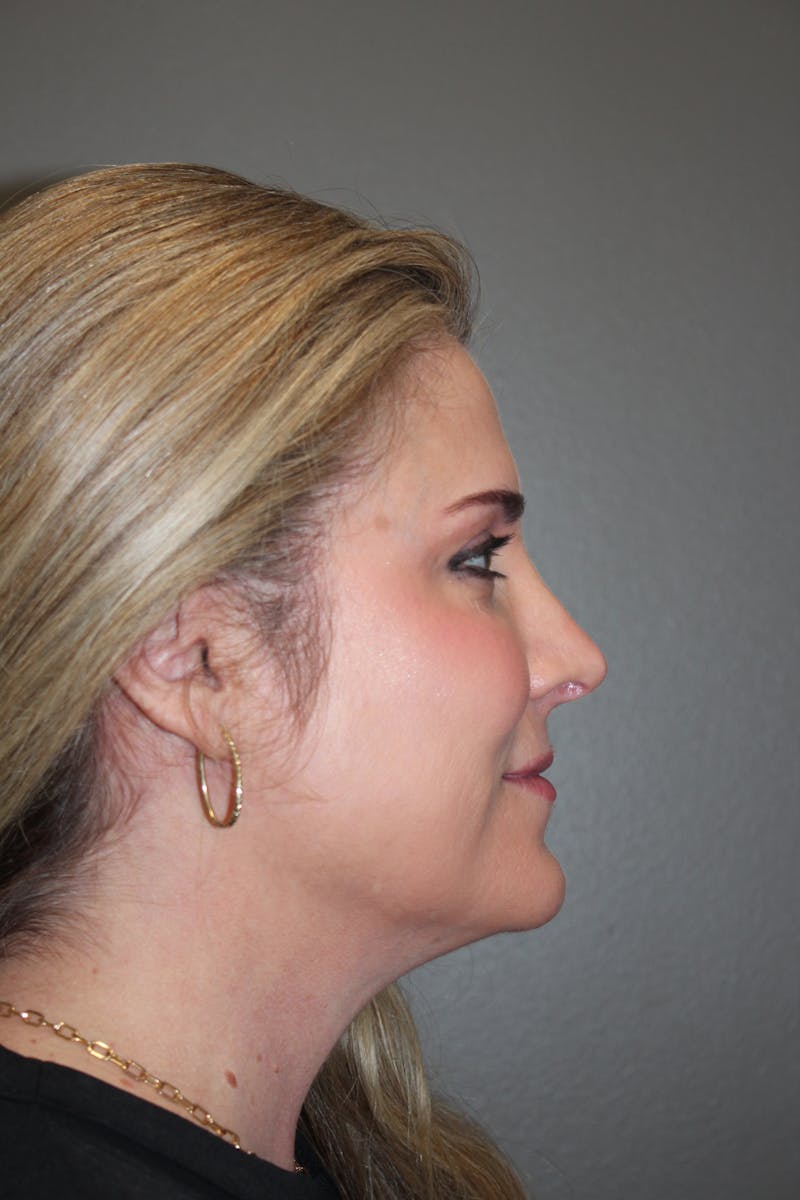 Rhinoplasty Before & After Gallery - Patient 141113650 - Image 2