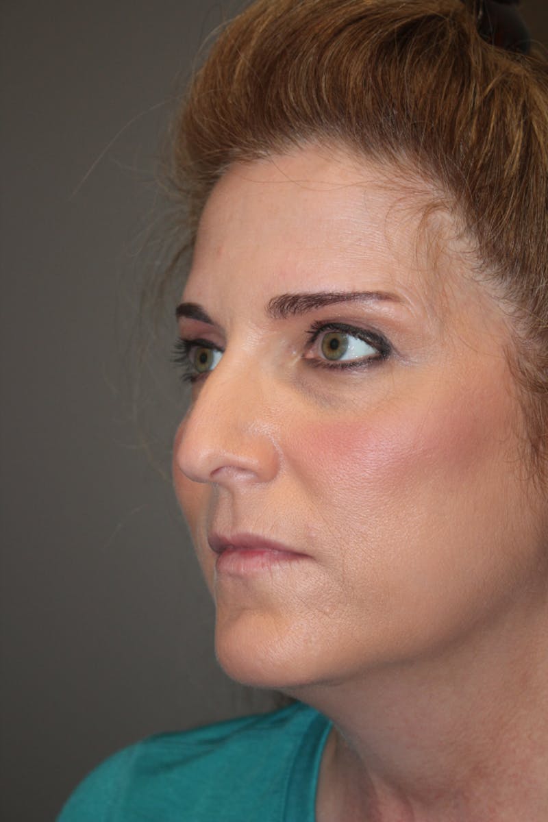 Rhinoplasty Before & After Gallery - Patient 141113650 - Image 5
