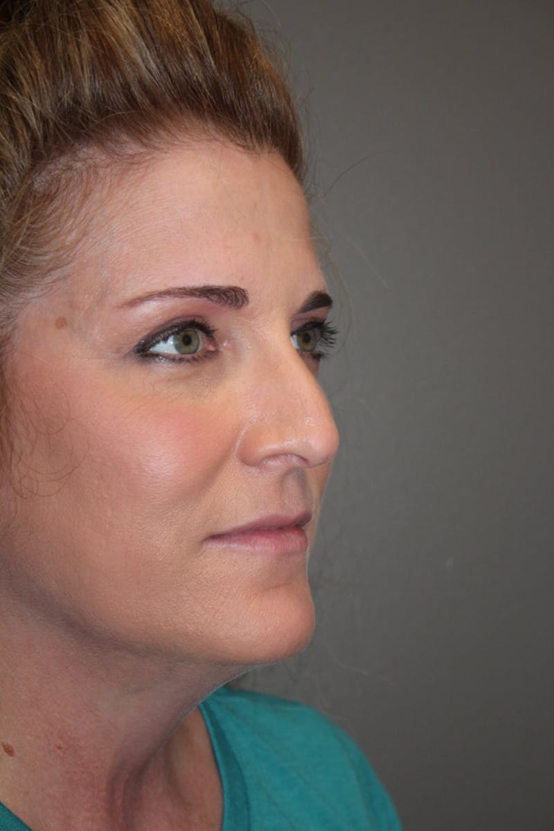 Rhinoplasty Before & After Gallery - Patient 141113650 - Image 3