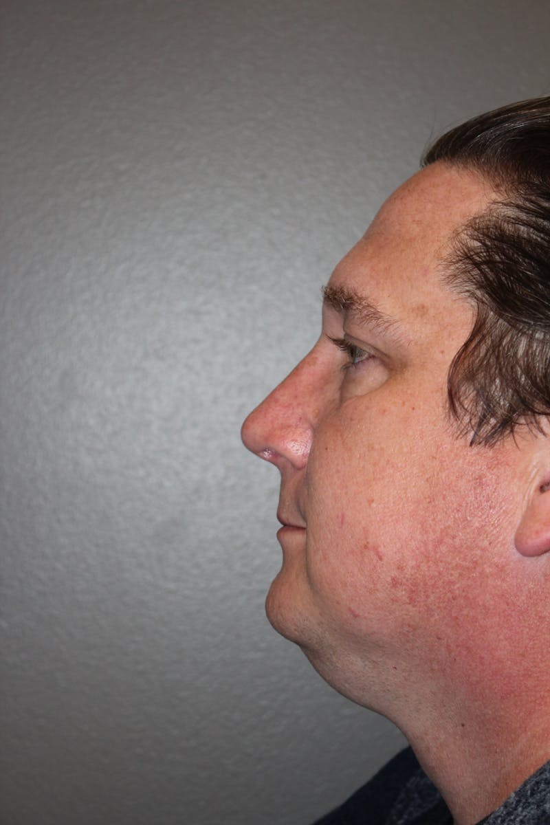 Rhinoplasty Before & After Gallery - Patient 141113649 - Image 6