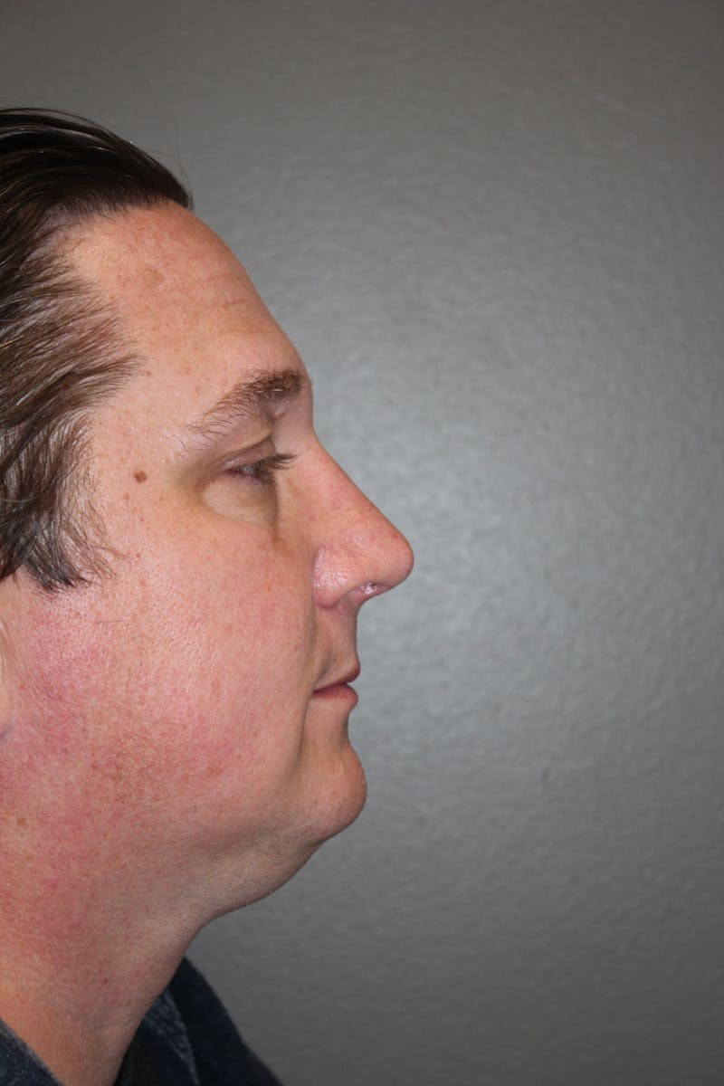 Rhinoplasty Before & After Gallery - Patient 141113649 - Image 2