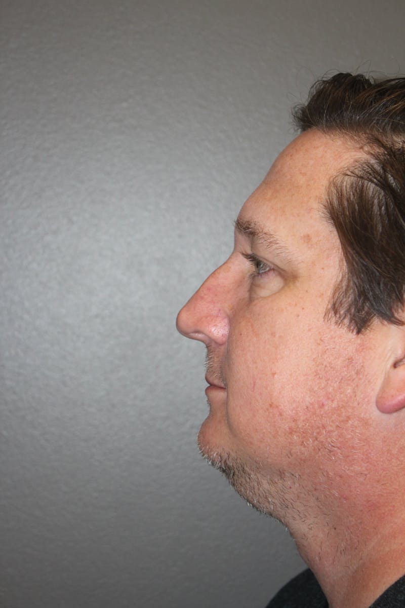 Rhinoplasty Before & After Gallery - Patient 141113649 - Image 5