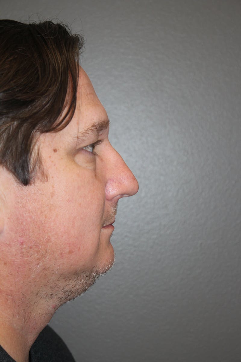 Rhinoplasty Before & After Gallery - Patient 141113649 - Image 1