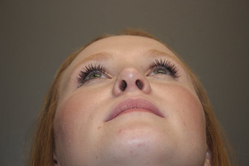 Rhinoplasty Before & After Gallery - Patient 141113648 - Image 10