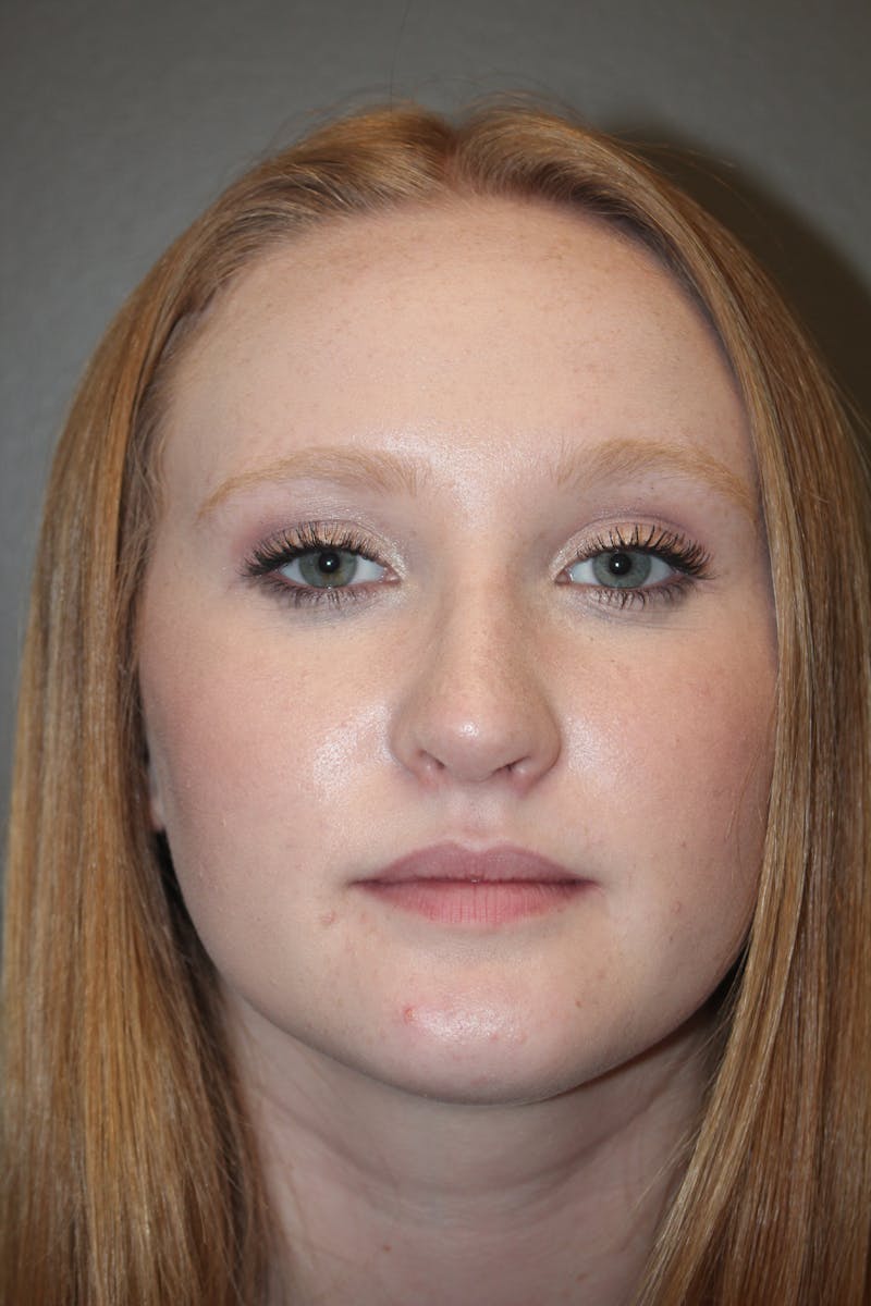 Rhinoplasty Before & After Gallery - Patient 141113648 - Image 8