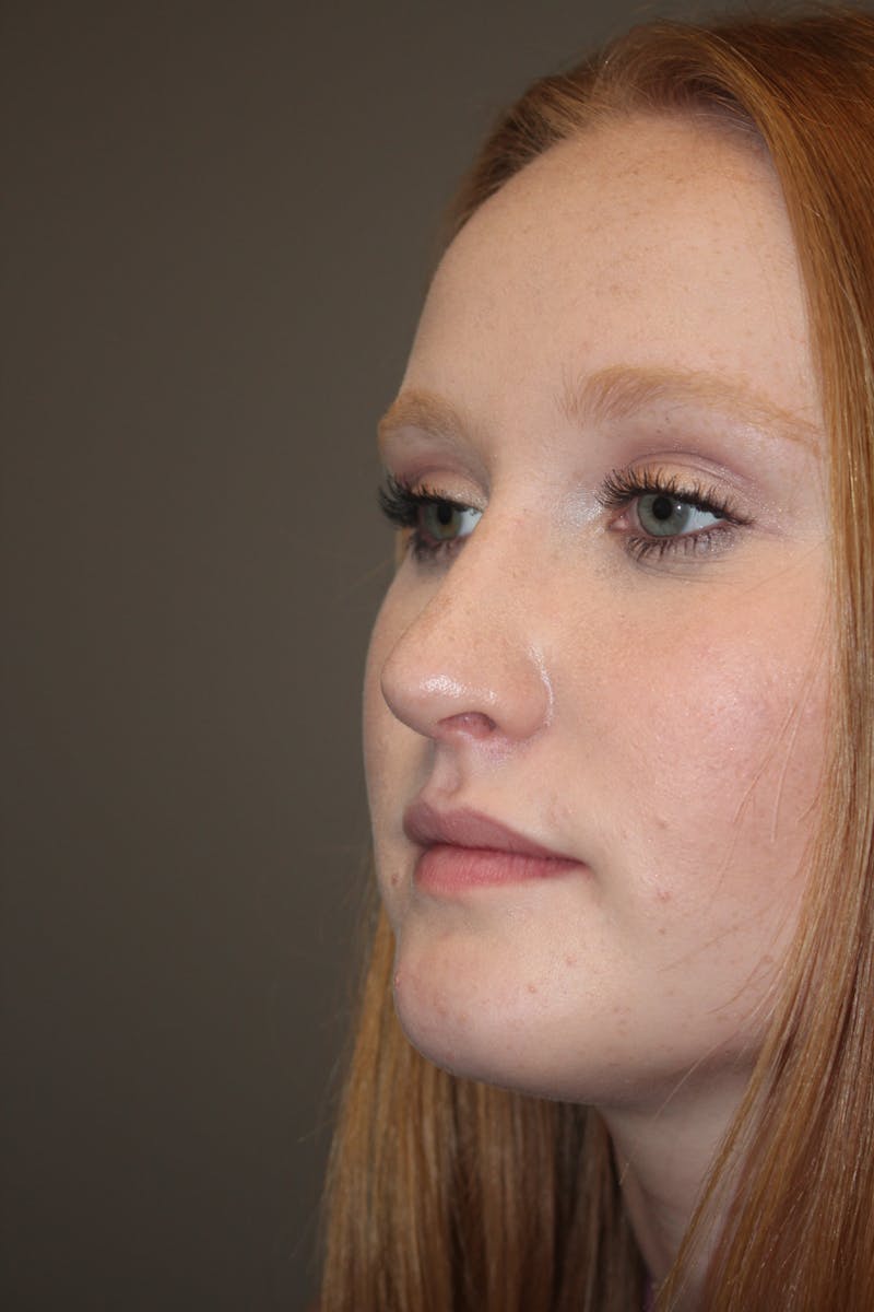 Rhinoplasty Before & After Gallery - Patient 141113648 - Image 5