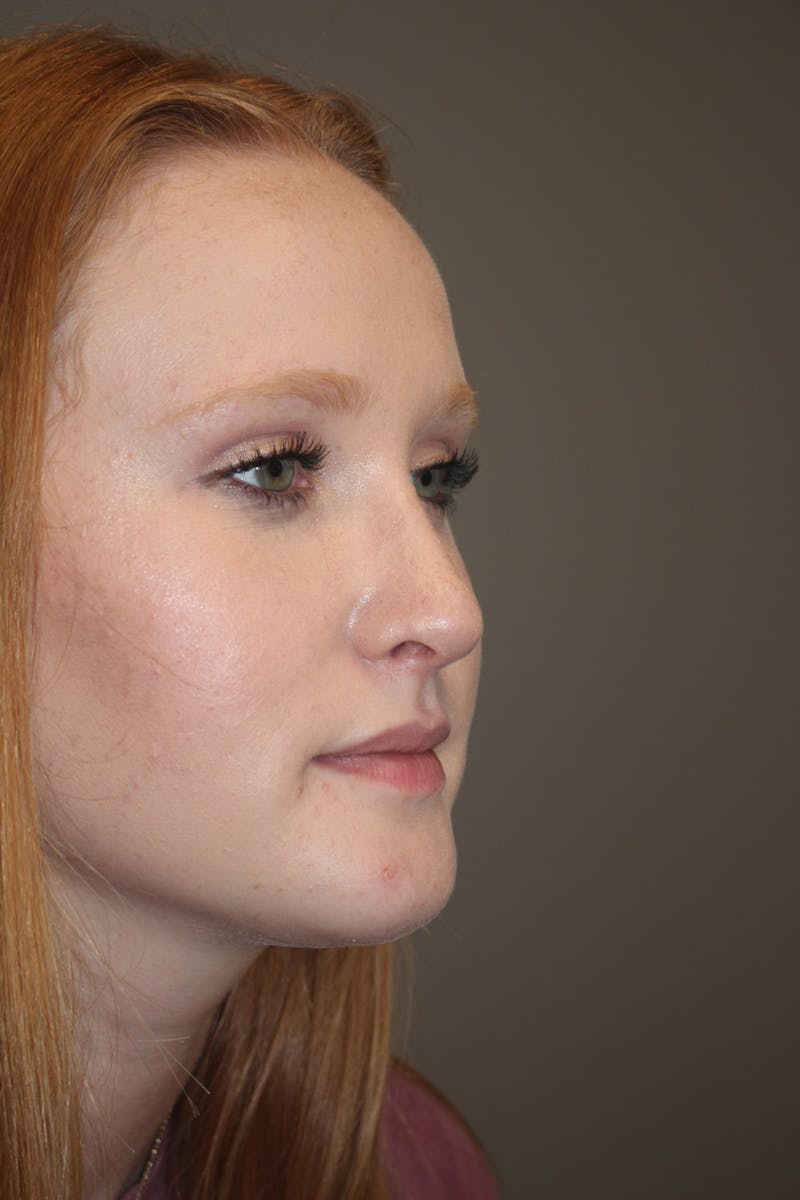 Rhinoplasty Before & After Gallery - Patient 141113648 - Image 4