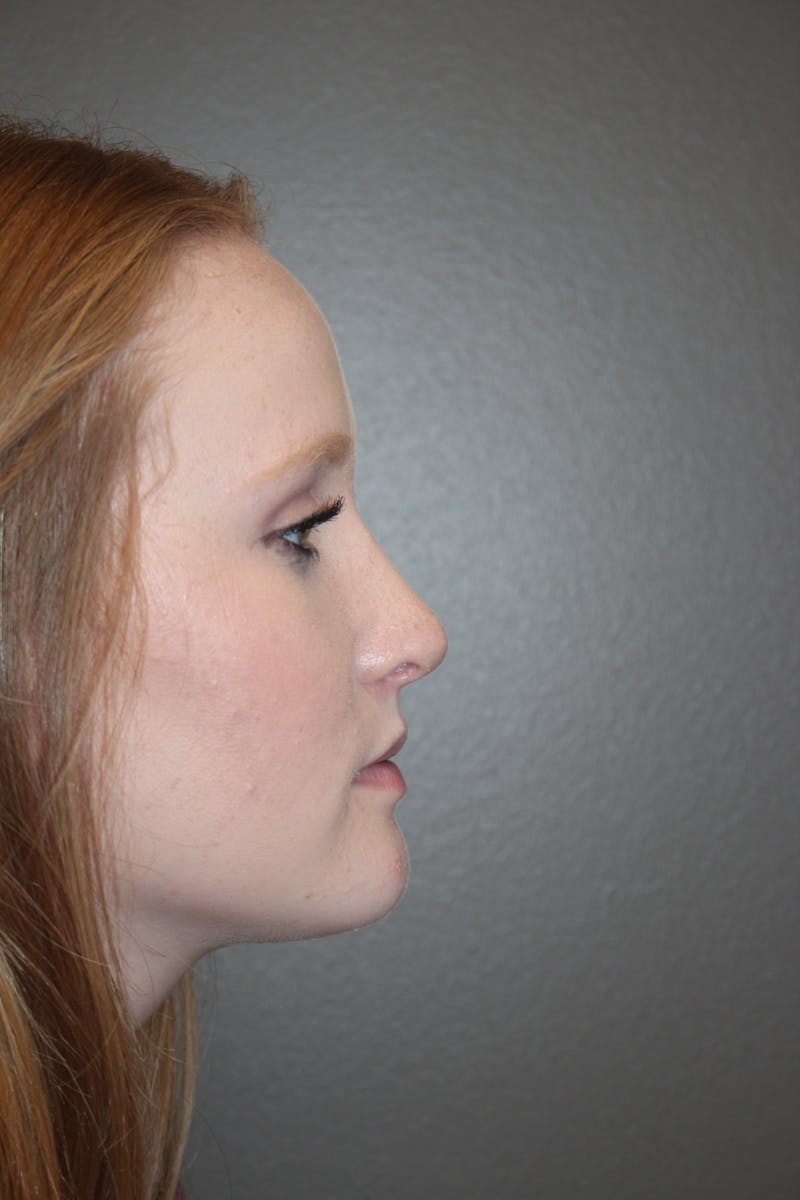 Rhinoplasty Before & After Gallery - Patient 141113648 - Image 2