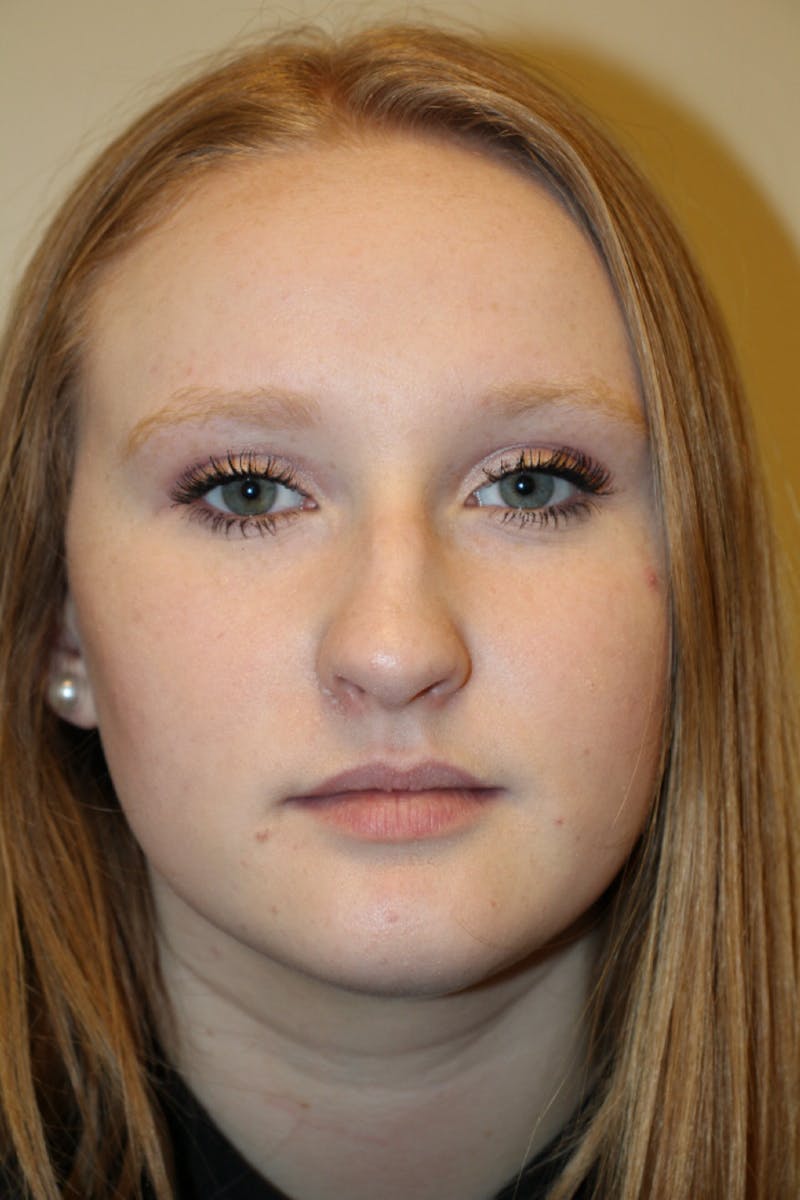 Rhinoplasty Before & After Gallery - Patient 141113648 - Image 7