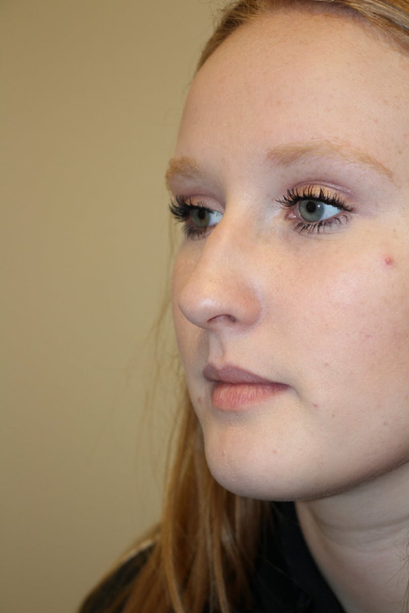 Rhinoplasty Before & After Gallery - Patient 141113648 - Image 6