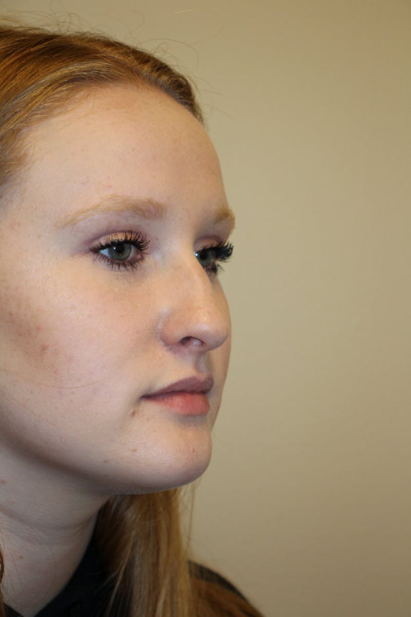 Rhinoplasty Before & After Gallery - Patient 141113648 - Image 3