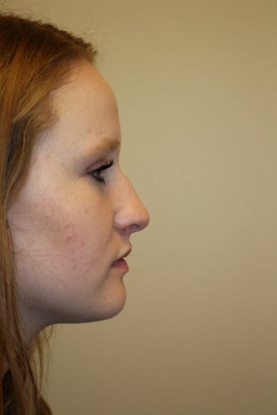 Rhinoplasty Before & After Gallery - Patient 141113648 - Image 1