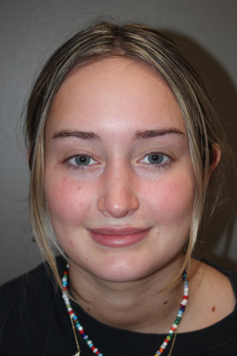 Rhinoplasty Before & After Gallery - Patient 141113632 - Image 8