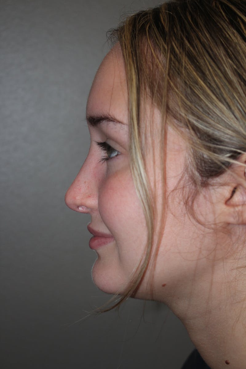 Rhinoplasty Before & After Gallery - Patient 141113632 - Image 6