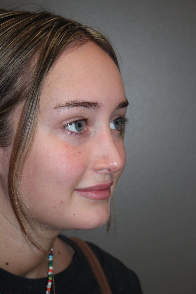 Rhinoplasty Before & After Gallery - Patient 141113632 - Image 4