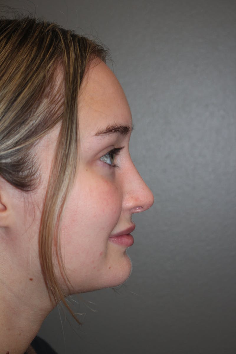 Rhinoplasty Before & After Gallery - Patient 141113632 - Image 2