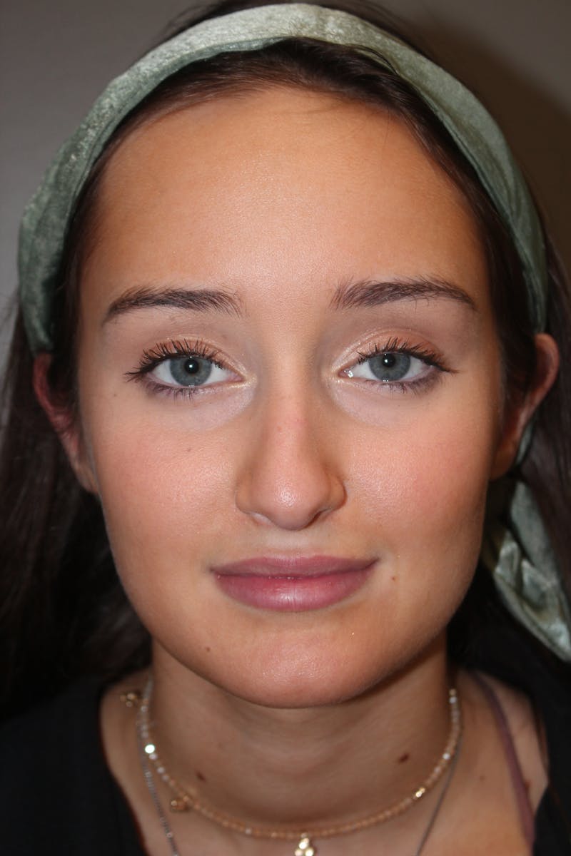 Rhinoplasty Before & After Gallery - Patient 141113632 - Image 7