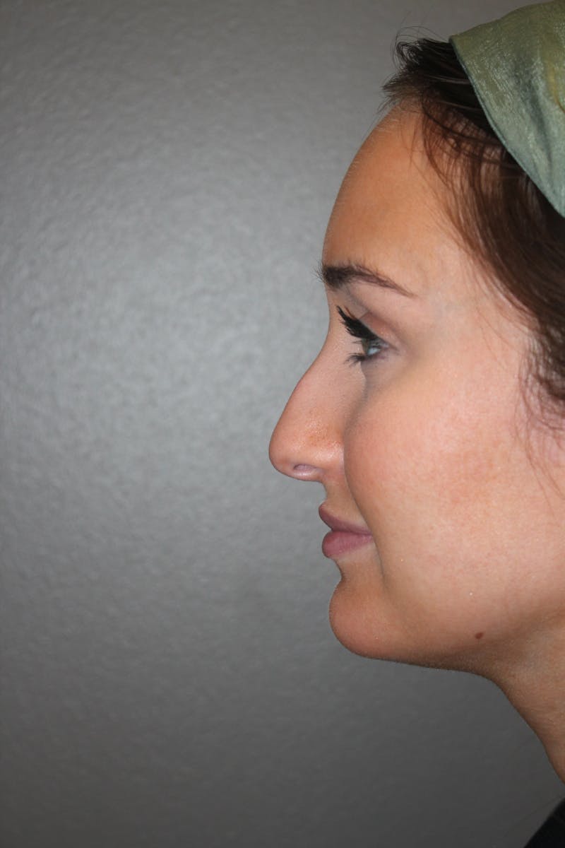 Rhinoplasty Before & After Gallery - Patient 141113632 - Image 5