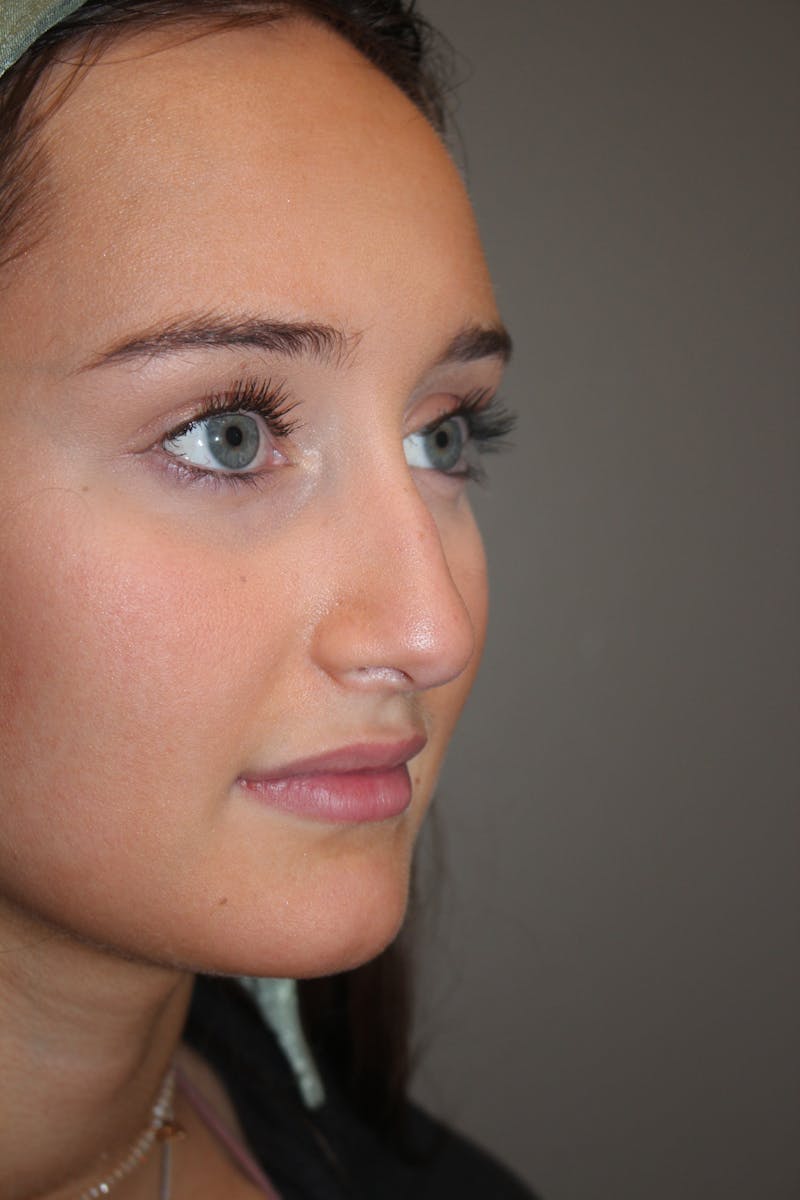 Rhinoplasty Before & After Gallery - Patient 141113632 - Image 3