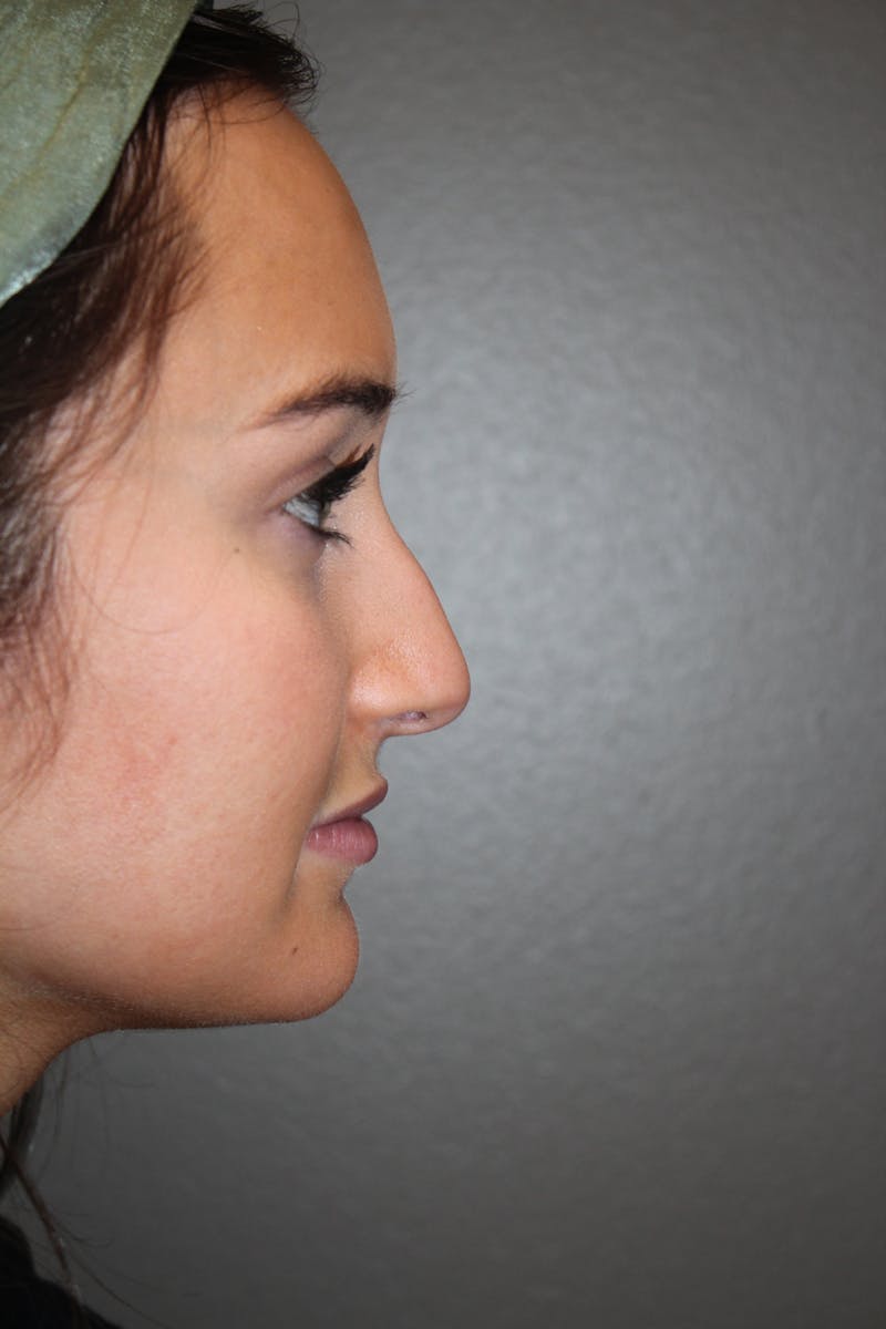 Rhinoplasty Before & After Gallery - Patient 141113632 - Image 1