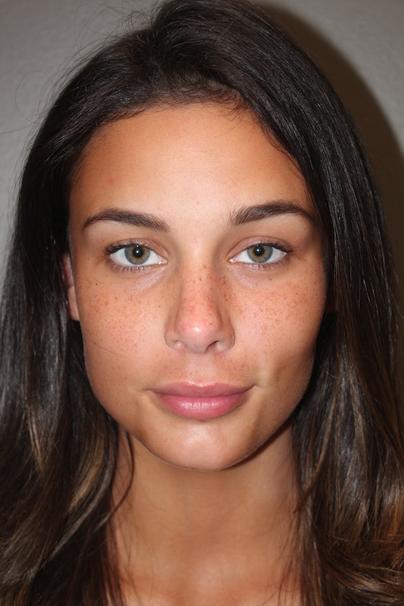 Rhinoplasty Before & After Gallery - Patient 141113628 - Image 10