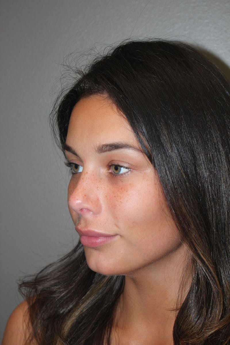Rhinoplasty Before & After Gallery - Patient 141113628 - Image 8
