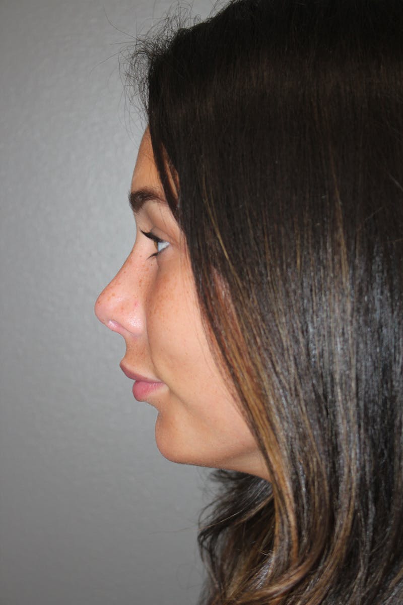 Rhinoplasty Before & After Gallery - Patient 141113628 - Image 6