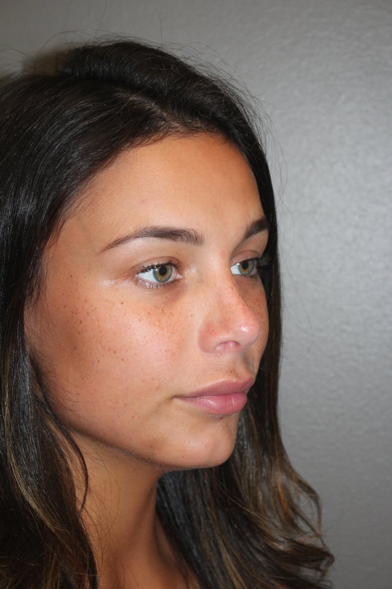 Rhinoplasty Before & After Gallery - Patient 141113628 - Image 4