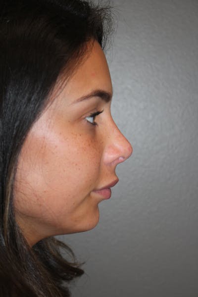 Rhinoplasty Before & After Gallery - Patient 141113628 - Image 2