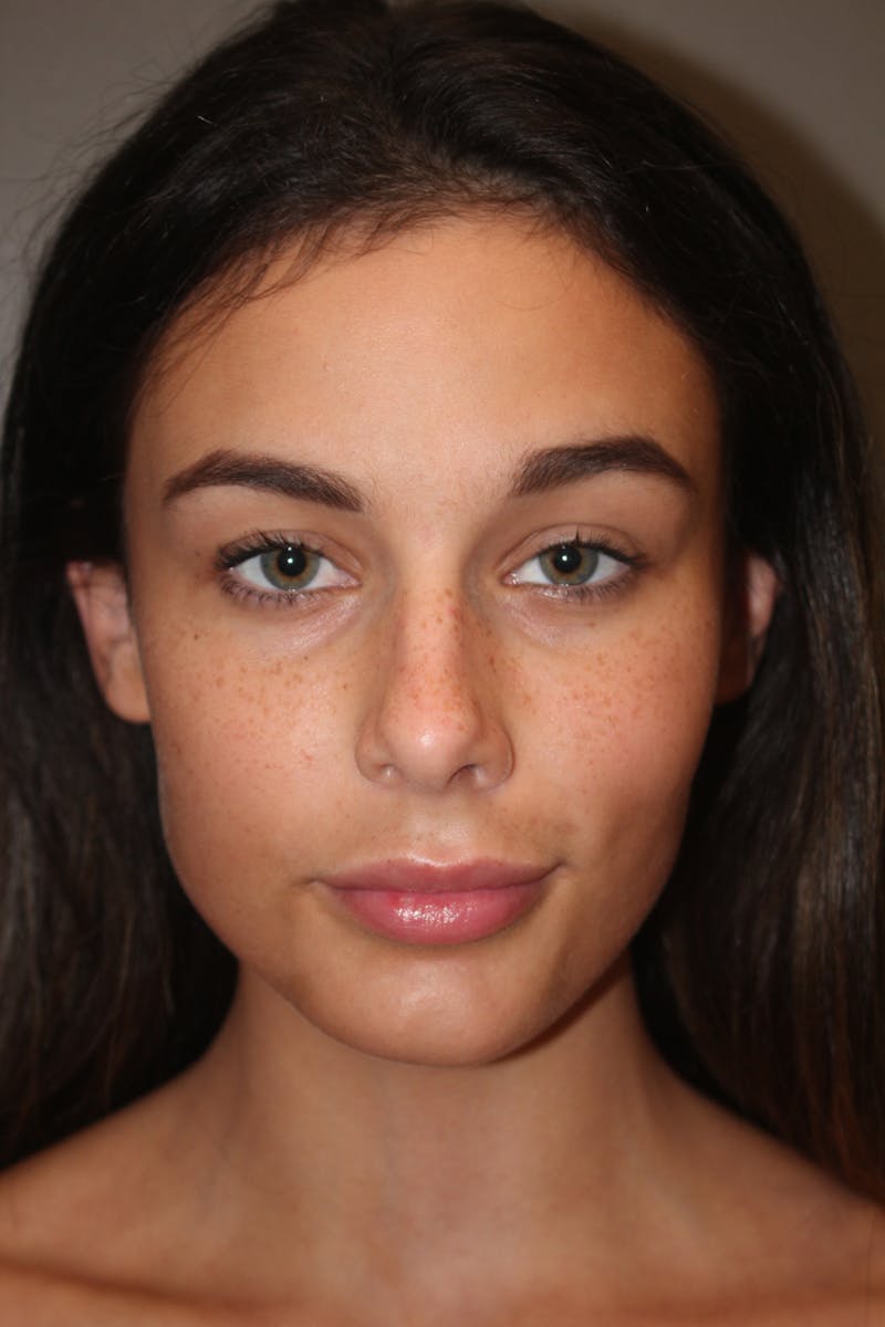 Rhinoplasty Before & After Gallery - Patient 141113628 - Image 9