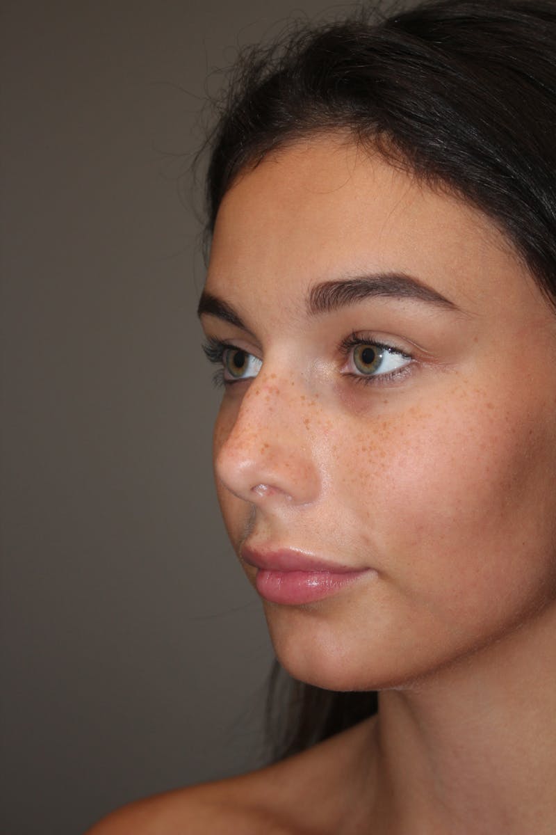 Rhinoplasty Before & After Gallery - Patient 141113628 - Image 7