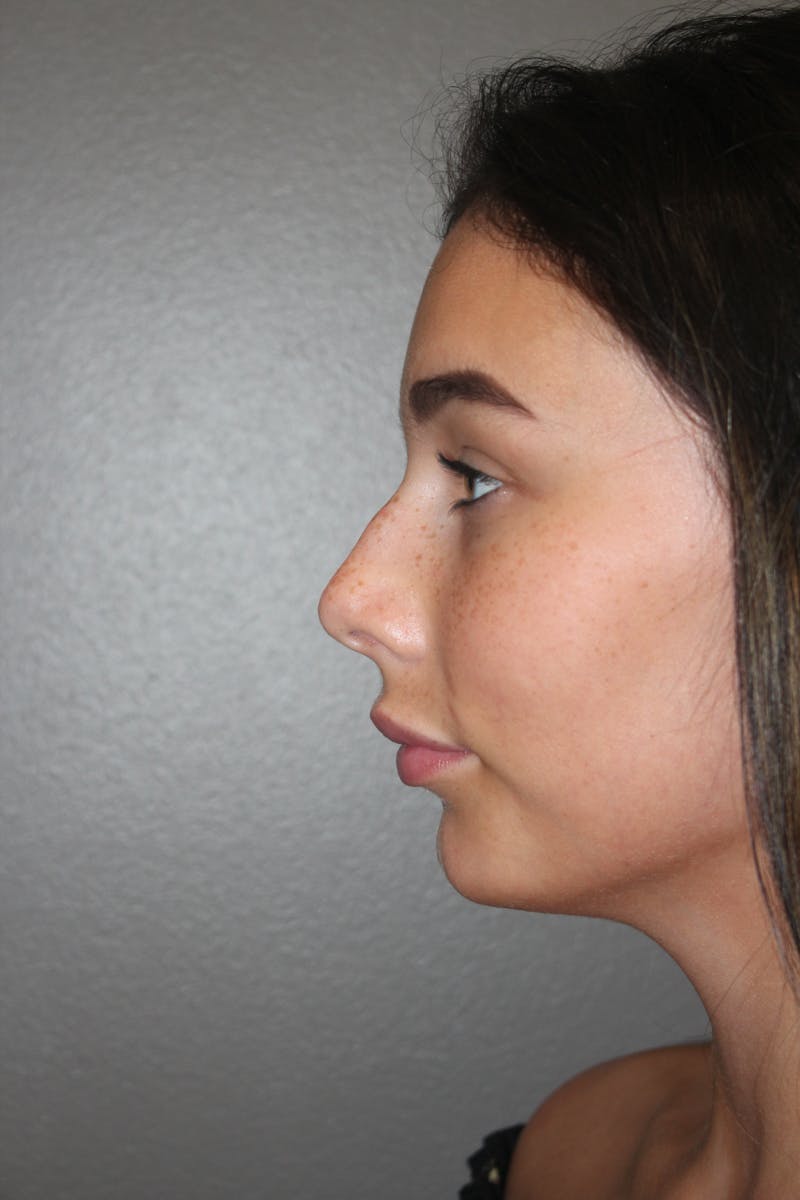 Rhinoplasty Before & After Gallery - Patient 141113628 - Image 5