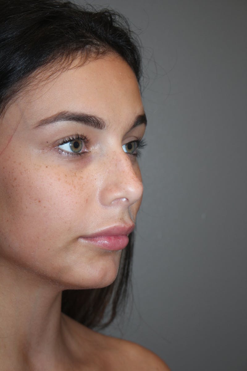 Rhinoplasty Before & After Gallery - Patient 141113628 - Image 3