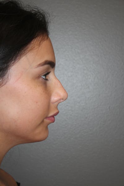 Rhinoplasty Before & After Gallery - Patient 141113628 - Image 1