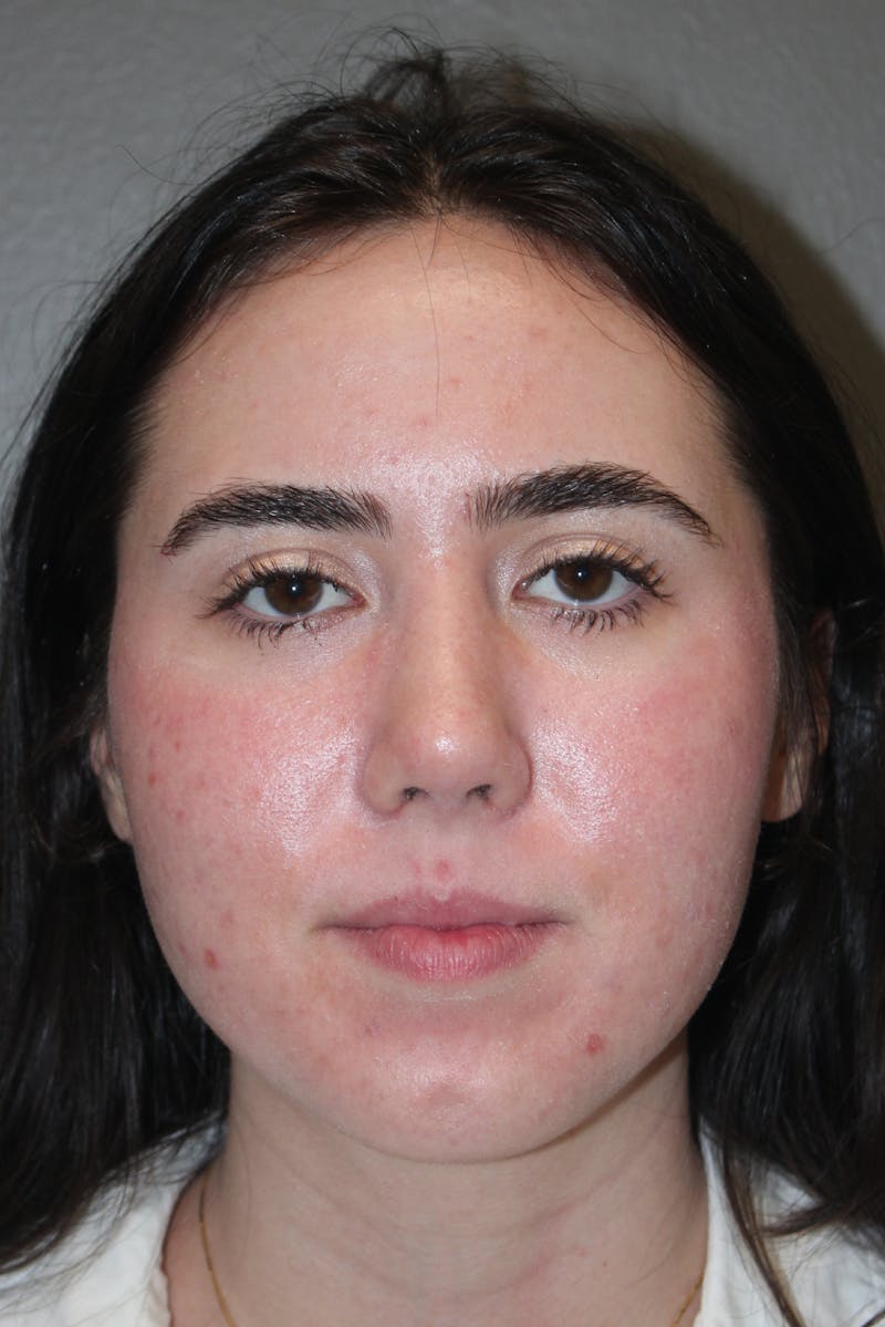Rhinoplasty Before & After Gallery - Patient 141113626 - Image 8
