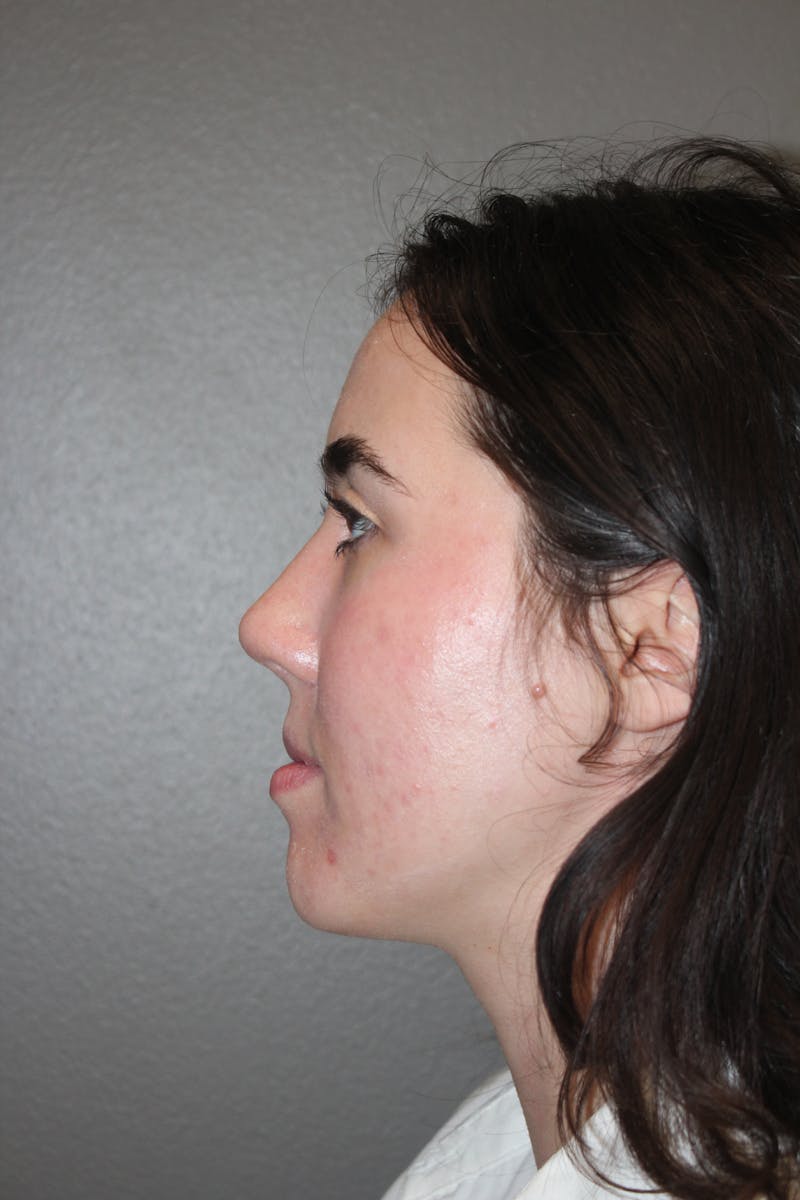 Rhinoplasty Before & After Gallery - Patient 141113626 - Image 6