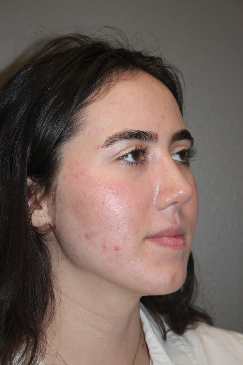 Rhinoplasty Before & After Gallery - Patient 141113626 - Image 4
