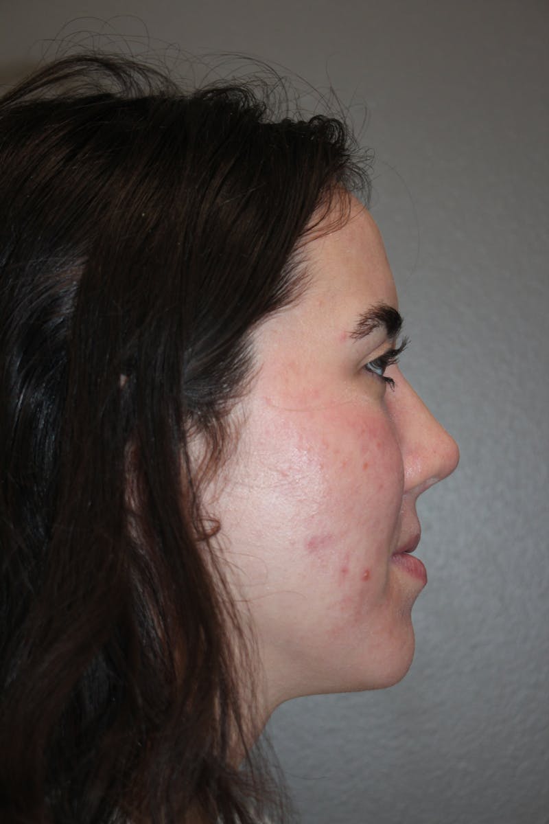 Rhinoplasty Before & After Gallery - Patient 141113626 - Image 2