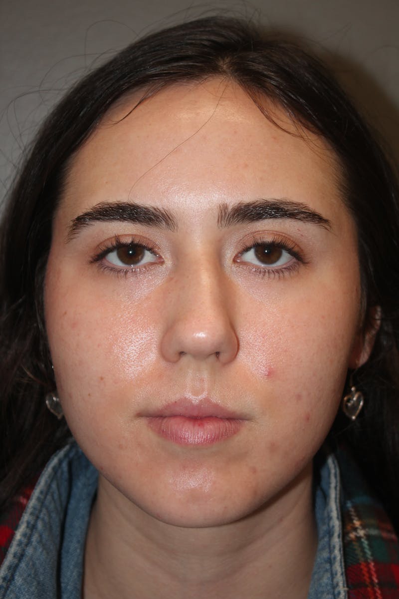 Rhinoplasty Before & After Gallery - Patient 141113626 - Image 7