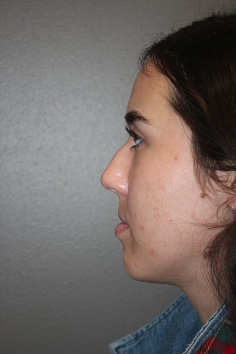 Rhinoplasty Before & After Gallery - Patient 141113626 - Image 5