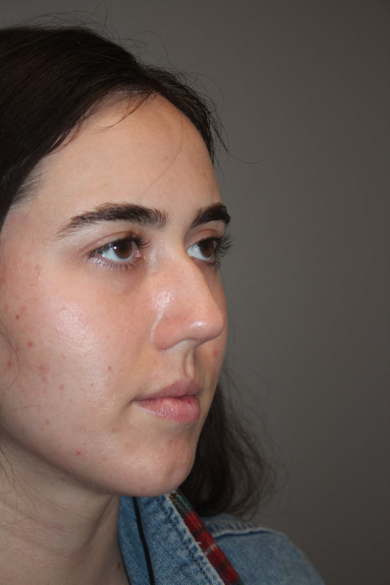 Rhinoplasty Before & After Gallery - Patient 141113626 - Image 3
