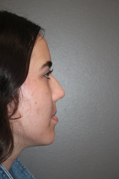 Rhinoplasty Before & After Gallery - Patient 141113626 - Image 1