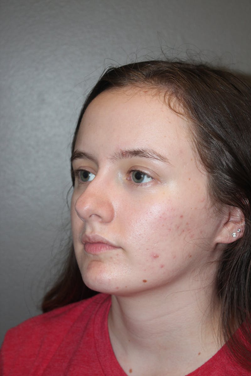 Rhinoplasty Before & After Gallery - Patient 141113621 - Image 5
