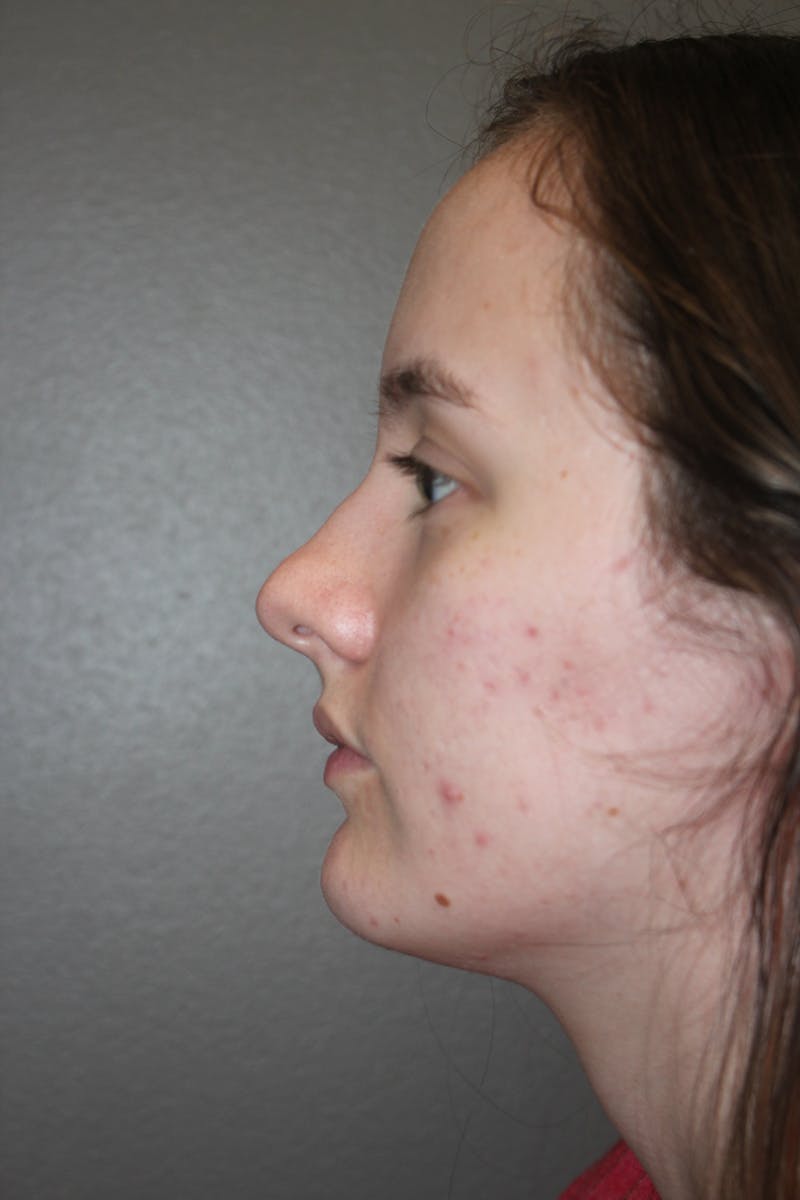 Rhinoplasty Before & After Gallery - Patient 141113621 - Image 7