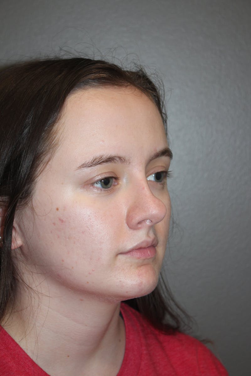 Rhinoplasty Before & After Gallery - Patient 141113621 - Image 3