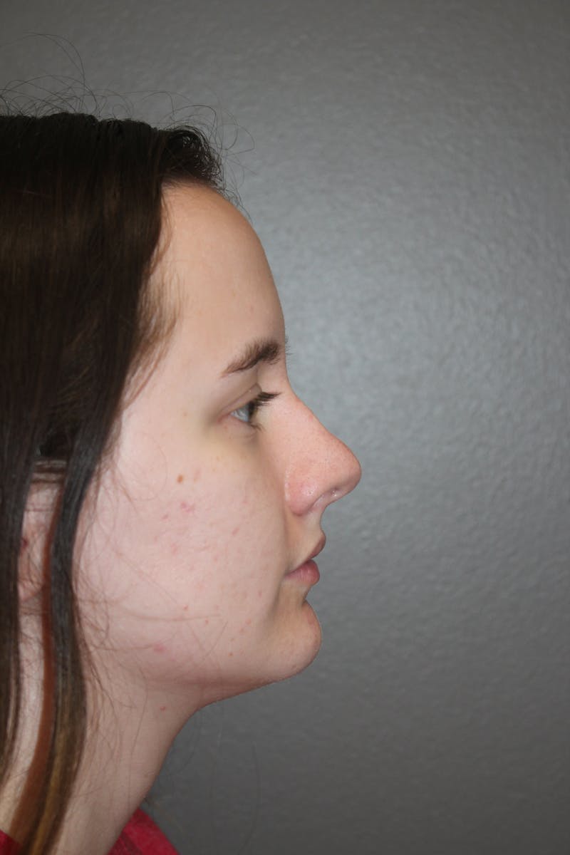 Rhinoplasty Before & After Gallery - Patient 141113621 - Image 1
