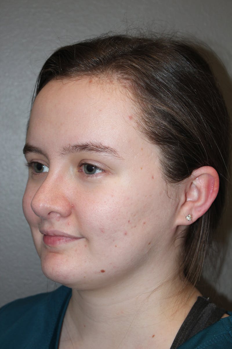 Rhinoplasty Before & After Gallery - Patient 141113621 - Image 6