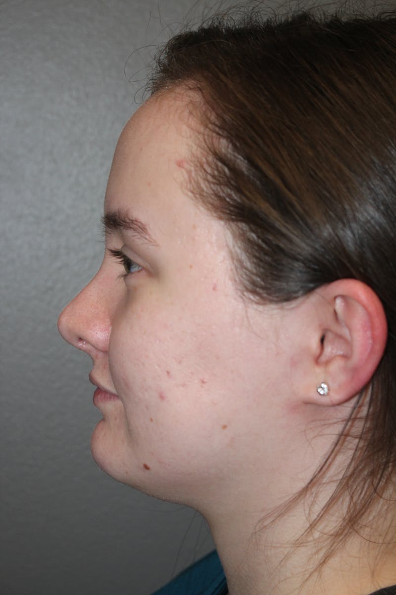 Rhinoplasty Before & After Gallery - Patient 141113621 - Image 8