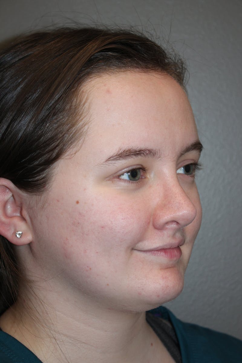 Rhinoplasty Before & After Gallery - Patient 141113621 - Image 4